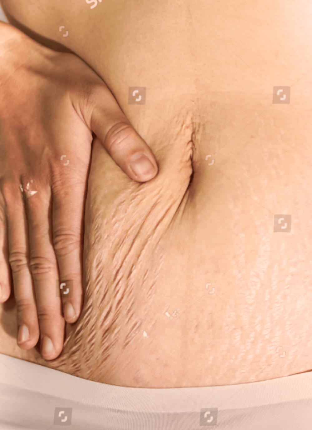 Skin Tightening and Waist Reduction